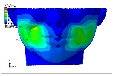 模拟颧肌收缩下的面部软组织变形，验证模型逼真度。