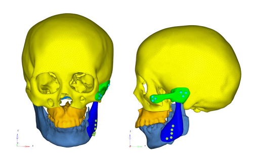 最大变形降至0.057mm，位于健侧冠突，整体稳定性提升。