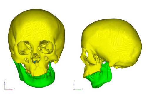 最大变形0.105mm，位于患侧下颌骨末端，结构刚度较弱。